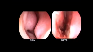 Diaphragm treatment with ultrasound