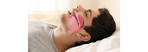 Obstructive Sleep Apnea (O.S.A)